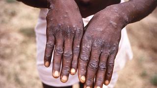 کارشناسان بهداشت: بعید است آبله میمون سناریویی شبیه به ویروس کرونا ایجاد کند